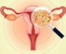 💖 Bacterial Vaginosis (BV): Symptoms, Causes, Diagnosis, And Treatment