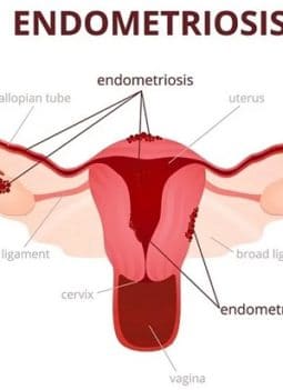 💖 Endometriosis: Symptoms, Causes, and Treatment