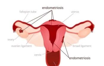 💖 Endometriosis: Symptoms, Causes, and Treatment