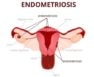 💖 Endometriosis: Symptoms, Causes, and Treatment