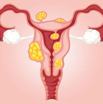 💖 Uterine Fibroid: Types, Symptoms, Causes and Treatment