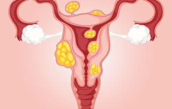 💖 Uterine Fibroid: Types, Symptoms, Causes and Treatment