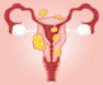 💖 Uterine Fibroid: Types, Symptoms, Causes and Treatment