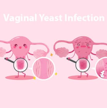 💖 Vaginal Yeast Infection: Causes, Symptoms, Treatment and Home Remedies