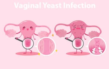 💖 Vaginal Yeast Infection: Causes, Symptoms, Treatment and Home Remedies