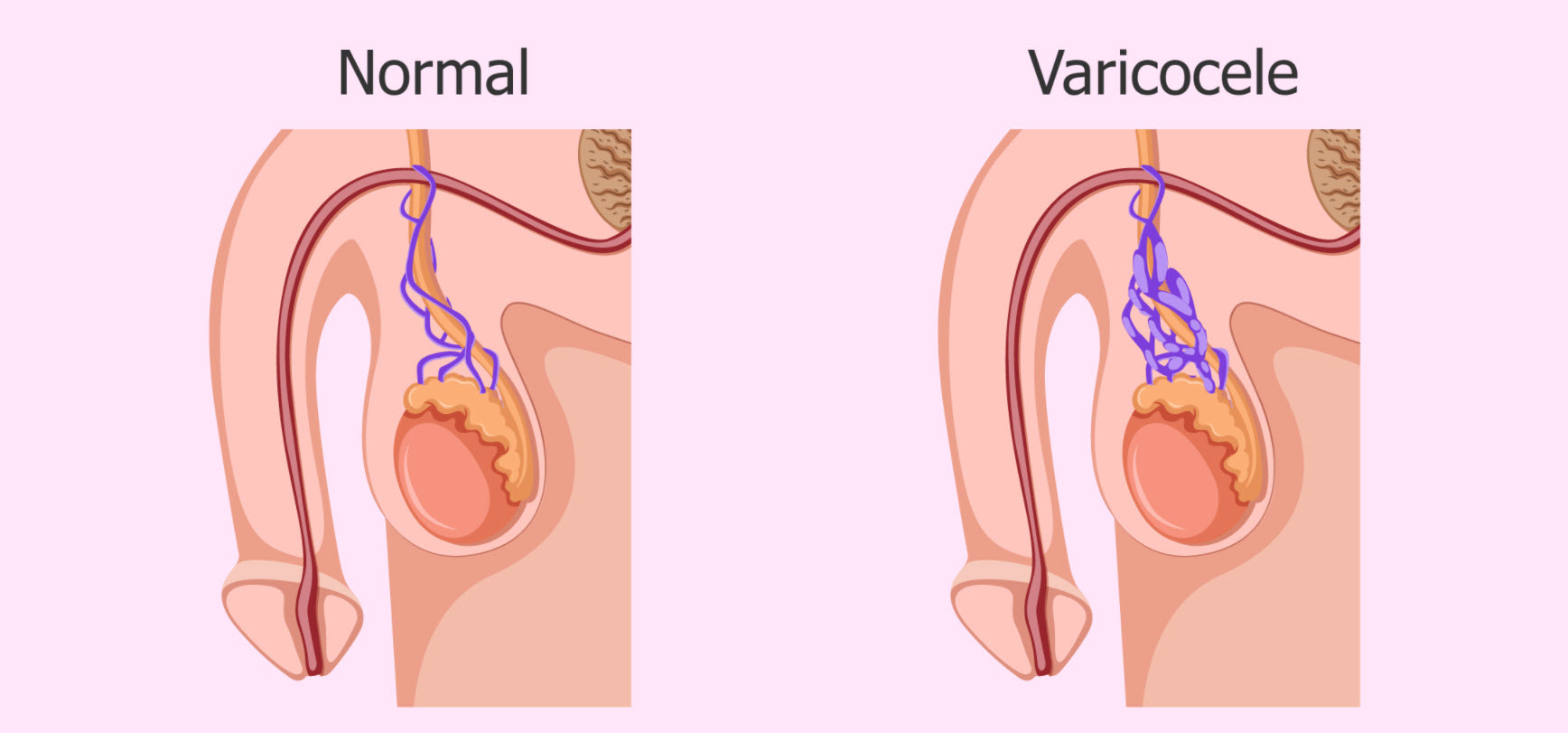 Position of varicocele