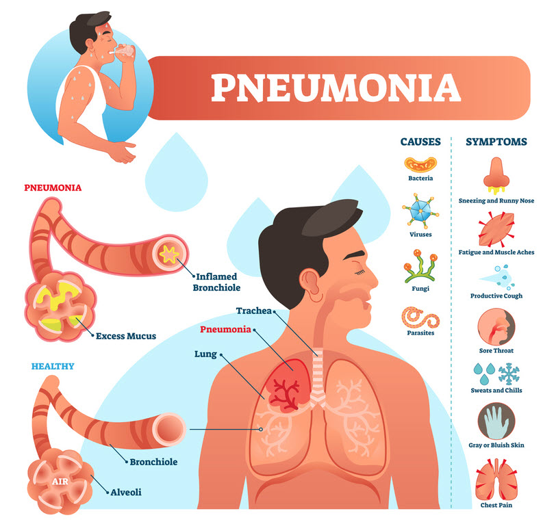Symptoms of pneumonia