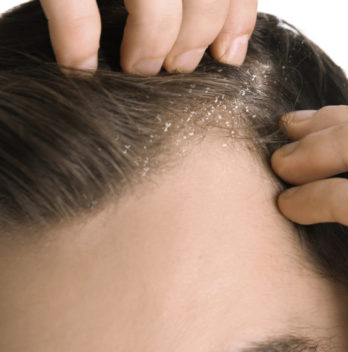 💖 13 Home Remedies To remove Dandruff Permanently