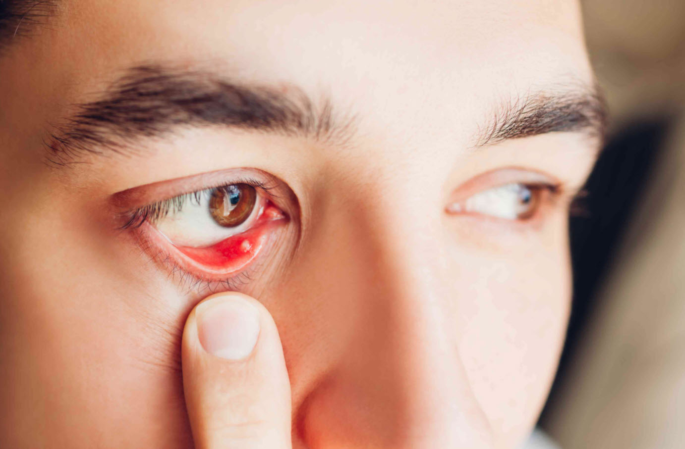 What causes a stye