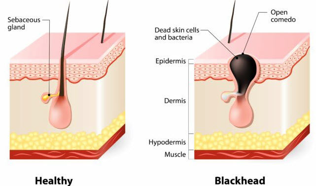 What causes blackheads