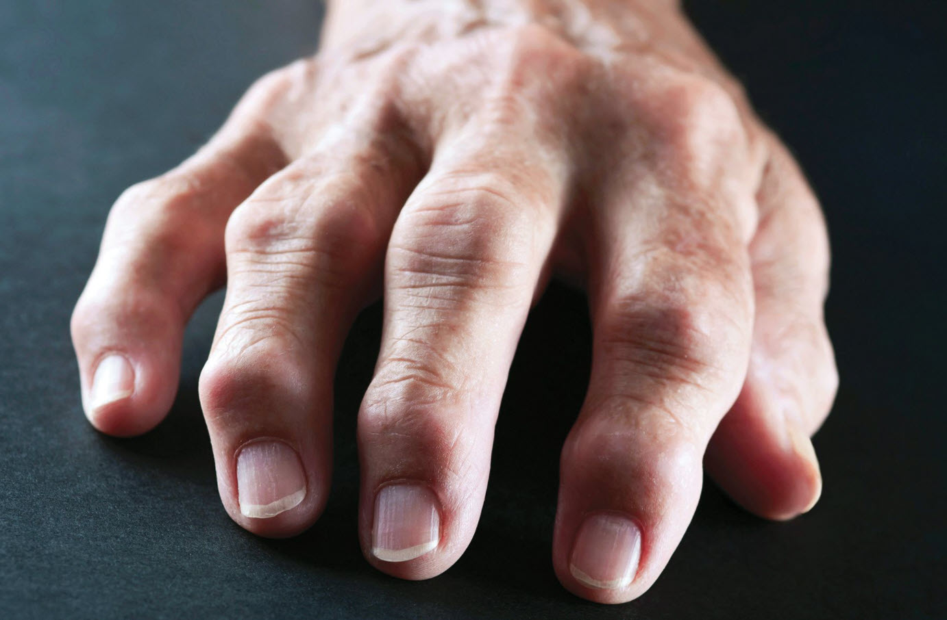 What is Rheumatoid arthritis