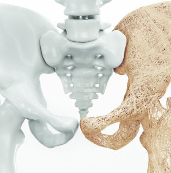 What is bone density
