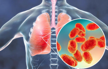 💖 Pneumonia: Types, Causes, Symptoms, Diagnosis and Treatment