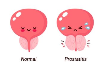 💖 How Prostatitis Is Diagnosed? Prostatitis: Types, Symptoms, and More