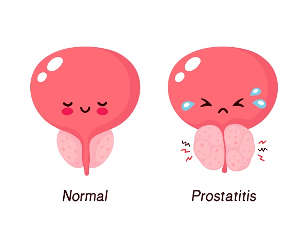How Prostatitis Is Diagnosed