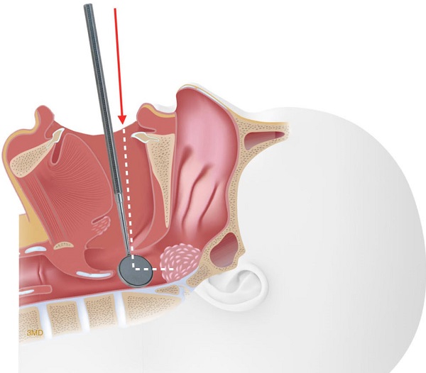 What Is An Adenoidectomy