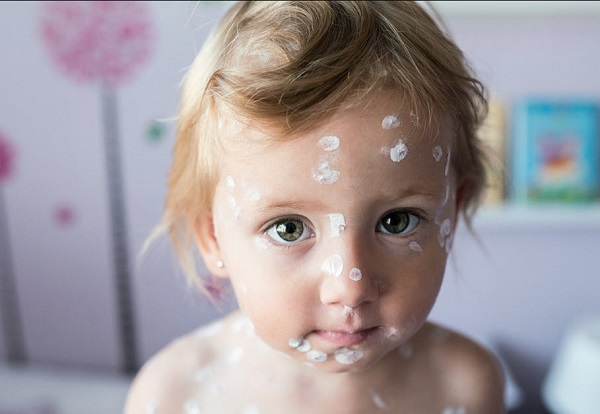 What if my baby gets chickenpox