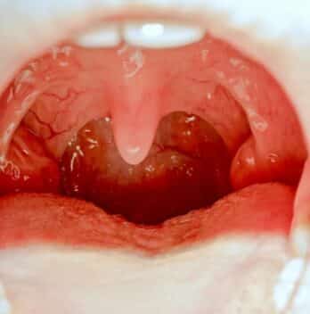 When Tonsils Are Removed?