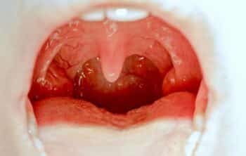 When Tonsils Are Removed?